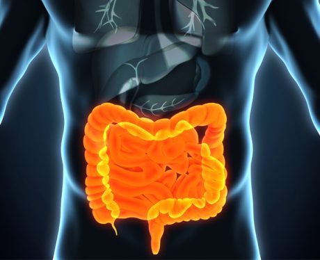 cirurgia-do-intestino-460x374